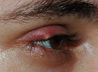 Stye (Sty): Eyelid Infection Symptoms, Causes, and Treatment