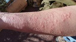 Hives (Urticaria): Causes, Symptoms, and Treatment