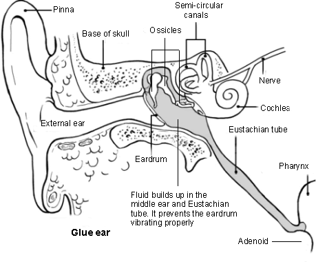 Glue Ear Causes Symptoms And Treatment glue-ear-causes-symptoms-and-treatment