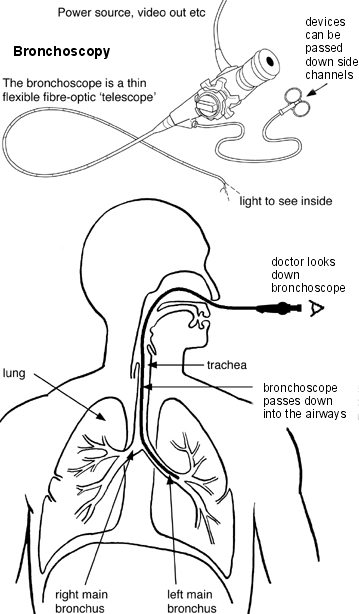 Bronchoscopy Checklist.pdf Bronchoscopy: What to expect