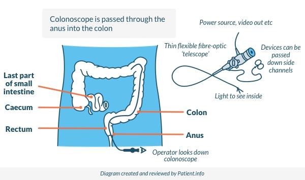 Colon Checked Colonoscopy: Test Use, Preparation, and Side-Effects