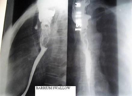 Swallow Test Barium Tests (Barium Meal, Swallow, Follow Through)