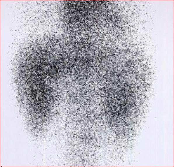 DMSA Scan: Overview and Side-Effects