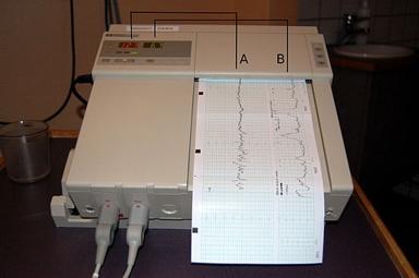 Cardiotocography (Baby heartbeat monitor during labour and delivery)