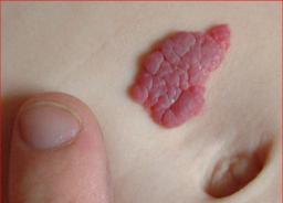 Strawberry Naevus Causes Symptoms And Treatment strawberry-naevus-causes-symptoms-and-treatment