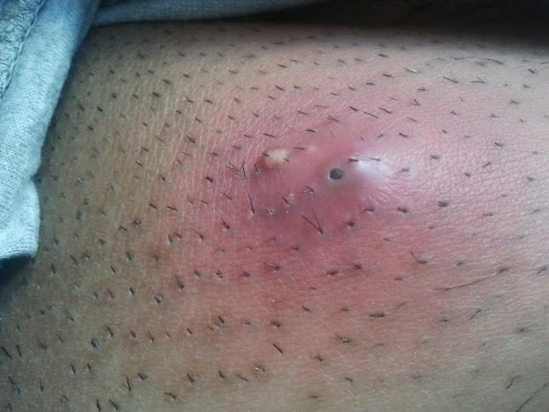 Abscess: Types, Causes, Symptoms, and Treatment