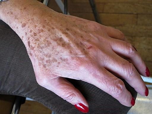 Lentigo Rash Lentigo: Causes, Symptoms, and Treatment | Doctor